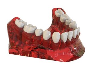 Co lepsze implant czy korona?